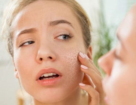 The Science Behind Acne